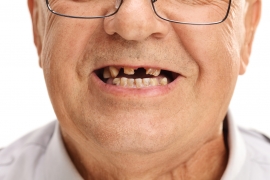 Ученые выяснили, что потеря зубов повышает риск смерти